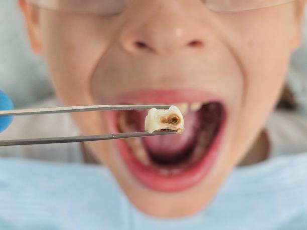 Best Emergency Treatment for Dental Infections or Abscesses in Makakilo, HI